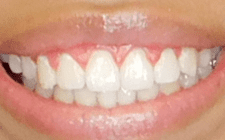 Arius After-Teeth Open Bite