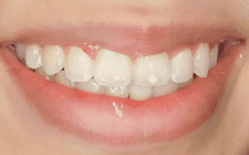 Ashley M After-Teeth Class II Extraction (New Section)