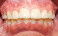 Dishaum J After- Overbite