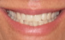 Jeannie S Before-Teeth Wider Smile
