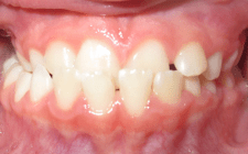 Jude E Before-Teeth Phase I Early Treatment