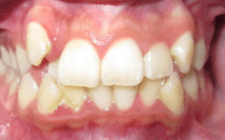 Kiona Before- Normal Bite