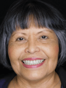 Linda Markle After-Bracelift