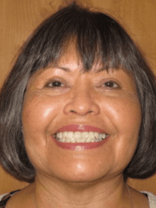 Linda Markle Before-Bracelift
