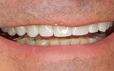 Mike Culver After-Teeth Combo Dental