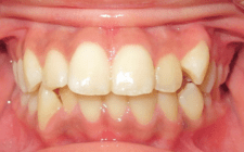 Shaydreanna Before- Wider Smile