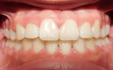 Shyla P After- Teeth Underbite
