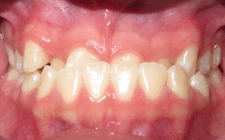 Shyla P Before- Teeth Underbite